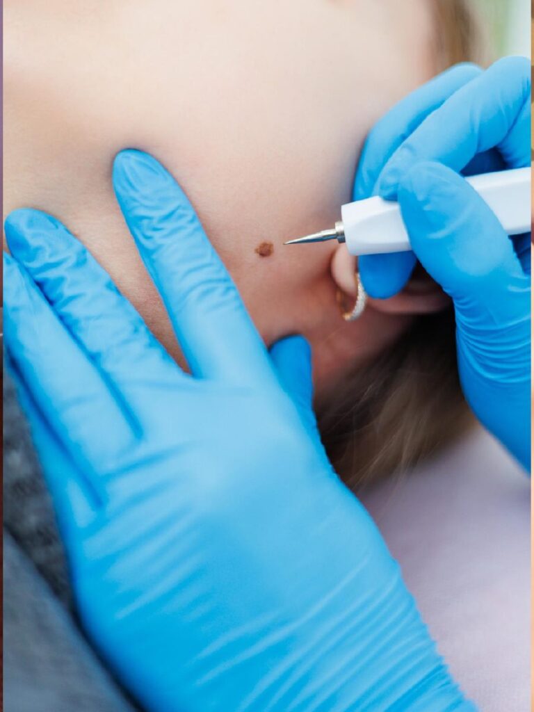 Laser Mole & Wart Removal in Dehradun at SKIHT clinic