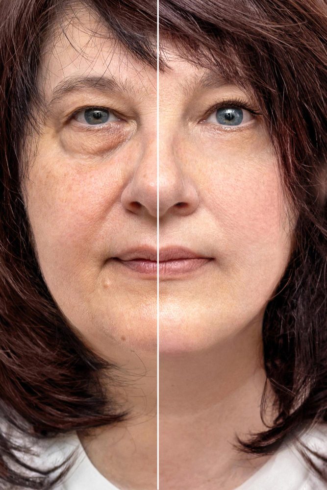 Skin Rejuvenation in Dehradun at SKIHT clinic