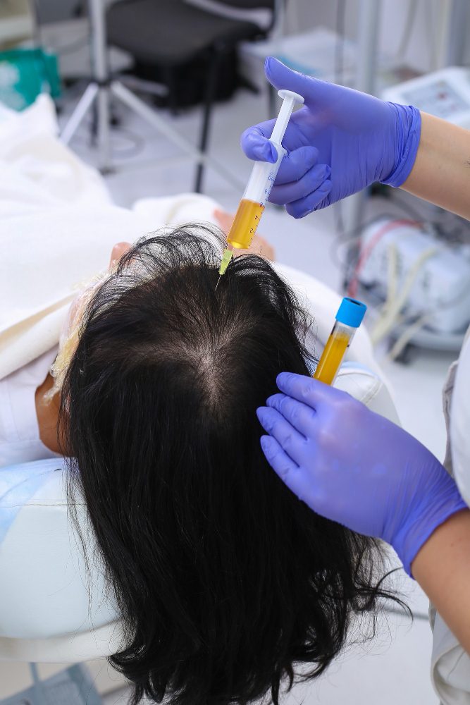 Dandruff Treatment in Dehradun at SKIHT clinic