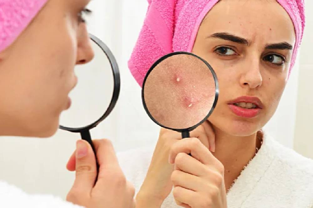 Acne Scar Removal
