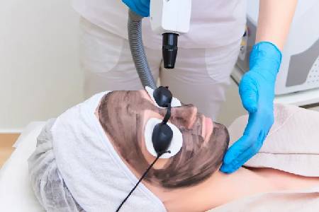 Carbon Laser Facial