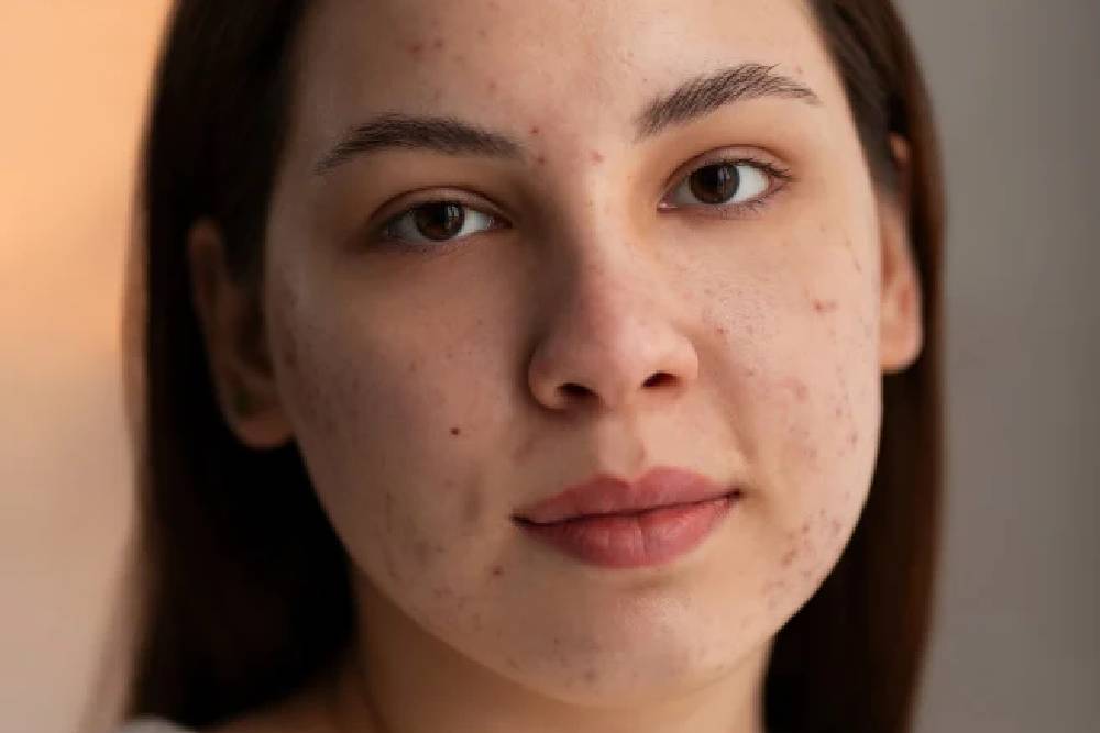 Dark Spot & Pigmentation