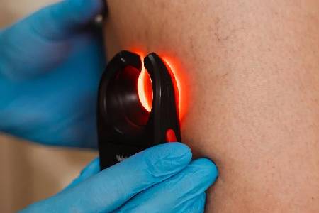 Laser Mole & Wart Removal