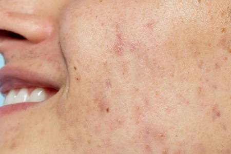 Pigmentation Laser Removal