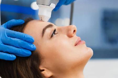 RF Skin Tightening (Face)