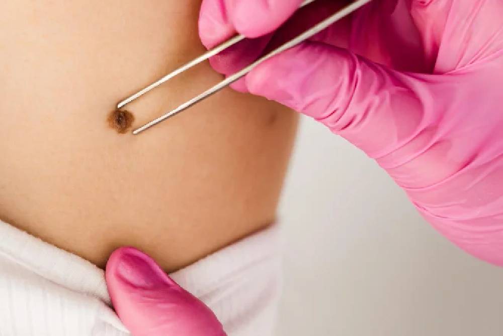 Warts / Mole Removal